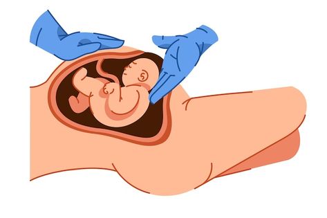 Hand drawn cesarean section illustrated | Free Vector #Freepik #freevector #pregnant-woman #pregnancy-woman #pregnant #pregnancy Pregnant Illustration, Sleep Cartoon, Cesarean Section, Drawings For Boyfriend, Turmeric Health, World Health Day, Girl Sleeping, Family Cartoon, Healthy Girl