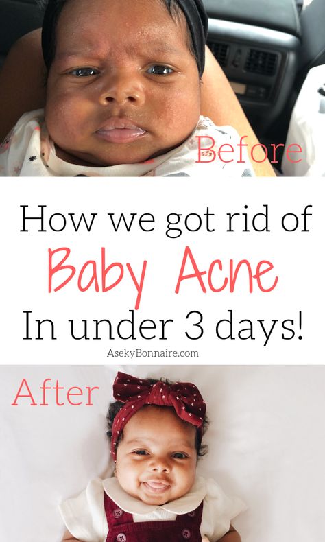 How to rid of baby acne Baby Acne Remedy, Baby Remedies, Baby Acne, Forehead Acne, Pregnancy Information, Pumping Moms, Baking Soda Shampoo, Baby Sleep Problems, Acne Remedies