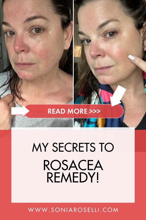 Before and after of a woman struggling with symptoms of a damaged skin barrier and rosacea. First image is red skin, dehydrated skin, irritated skin, sensitive skin. Second image is clear skin, hydrated skin, and rosacea free skin. Redness Skin, How To Fix Redness On Face, Face Redness Remedy, Facial Redness Remedies, Reduce Redness In Face, Reduce Facial Redness, Redness Reducing Skin Care, Cetaphil Acne, Redness Remedy