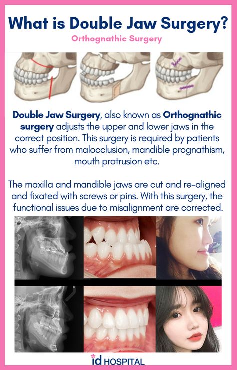 Many patients think they need double jaw surgery to get a smaller face! Orthognathic surgery is more of a functionality surgery. ID Hospital specializes in orthognathic surgeries and facial bone surgeries. Click here to find out more about this surgery! #idhospital #idhospitalkorea #plasticsurgery #koreanplasticsurgery #surgeryinkorea #facialcontouring #orthognathicsurgery #doublejawsurgery #malocclusion #mouthprotrusion #underbite #overbite #crossbite Orthognathic Surgery Before And After, Jaw Surgery Diet, Jaw Surgery Before And After, Upper Jaw Surgery, Jaw Surgery Recovery, Double Jaw Surgery Before And After, Dislocated Jaw, Maxillofacial Surgery, Jaw Surgery Before And After Overbite