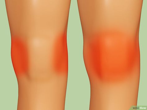 How to Heal a Meniscus Tear (with Pictures) Knee Meniscus, Knee Pain Relief Exercises, Patellofemoral Pain Syndrome, Knee Strength, Joints Pain Remedy, Knee Strengthening Exercises, How To Strengthen Knees, Ways To Heal, Knee Problem