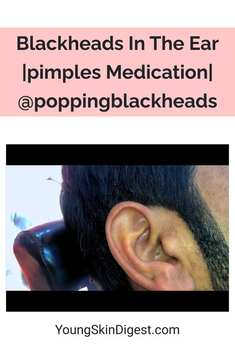 Blackheads In The Ear |pimples Medication| @poppingblackheads Ear Blackheads, Hard Pimple, Acne Recipes, Huge Blackheads, Ear Pimple, Squeezing Blackheads, Pimple Solution, Pimple Extraction, Pimple Removal