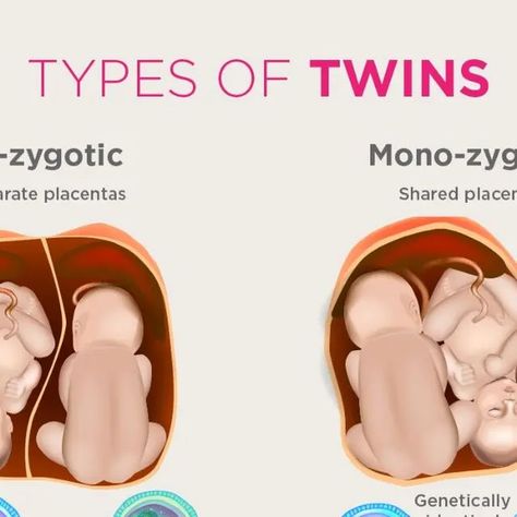 microbiologyupdate on Instagram: "TYPES OF TWINS !!! DO YOU KNOW ? 🤔🤔🤔🤔🤔🤔 There are two types of twins – identical (monozygotic) and fraternal (dizygotic). To form identical twins, one fertilised egg (ovum) splits and develops two babies with exactly the same genetic information. Such twins, known scientifically as 'MoMo', an abbreviation for monoamniotic-monochorionic, are some of the rarest types of twins, making up less than one percent of all births in the United States, noted the statement. It also stressed that such MoMo twin pregnancies have a high risk of fetal complications. Save it for future reference 😁 Share with your twin friends 😊 Thank you ❤️ . . . . . . . . #microbiologyupdate #twins #twinsbaby #monozygotic #monozygotictwins #dizygotic #dizygotictwins #ovum #fer Identical Twins Ultrasound, Twins Identical, Momo Twins, Types Of Twins, Twin Pictures, Fraternal Twins, Birth Rate, Newborn Mom, Fetal Development