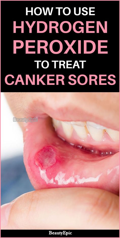 How to Use Hydrogen Peroxide To Treat Canker Sores Hydrogen Peroxide Acne, Canker Sore Remedy, Acne Cleaning, Peroxide Uses, Hydrogen Peroxide Uses, Canker Sore, Oral Care Routine, Receding Gums, Cold Sore