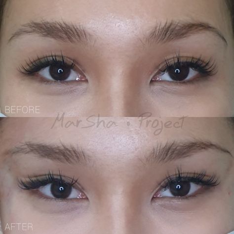 Fox Eye Lift Surgery, Cat Eye Surgery, Fox Eye Surgery Before And After, Upturned Eyes Aesthetic, Fox Eye Surgery, Fox Eye Lift, Eye Lift Surgery, Face Plastic Surgery, Nose Surgery Rhinoplasty