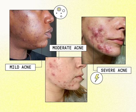 Acne Severities: How to Treat Mild, Moderate, and Severe Acne | Apostrophe Mild Acne, Moderate Acne, Acne Scar, Severe Acne, Acne Scar Removal, Scar Removal, Acne