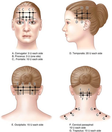 Botox For Migraine, Botox For Headaches, Botox Migraine, Botox Injection Sites, Injection Sites, Facial Injections, Botox Injection, Botox Lips, Facial Anatomy