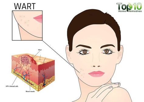 Face Diagram, Face Warts, Skin Tags On Face, Flat Warts, Types Of Warts, Facial Warts, Clear Skin Overnight, Warts On Face, Home Remedies For Warts