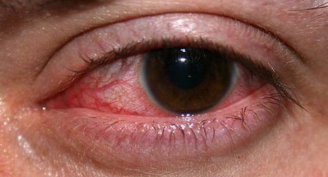 What to do if you have an inflamed eye...bc I have one right now :( Bloodshot Eyes, Dry Cracked Lips, Eye Twitching, Swollen Eyes, Parts Of The Eye, Irritated Eye, Eye Infections, Sore Eyes, Healthy Eyes