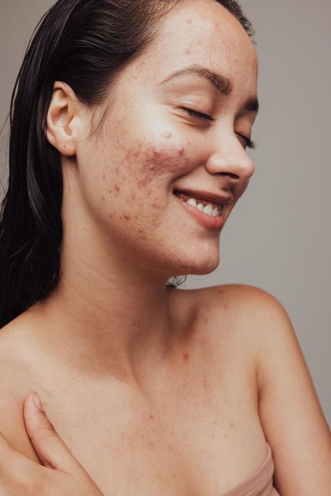 Acne Awareness Month, Acne Awareness, Acne Positivity, Glymed Plus, Skin Care Pictures, Acne Makeup, Skin Aesthetics, Real Skin, Gentle Skin Cleanser