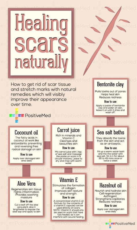 Natural Home Remedies, Natural Skin, Getting Rid Of Scars, Acne Treatments, Scar Tissue, Skin Healing, Health Remedies, Natural Healing, Natural Health