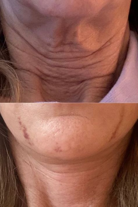 Say goodbye to neck wrinkles! Explore effective treatments and unlock the secrets to a smoother, youthful-looking neck. Creamed Turkey, Neck Tightening, Turkey Neck, Neck Wrinkles, Neck Cream, Beauty Images, Say Goodbye, Beauty Inspiration, Wrinkles