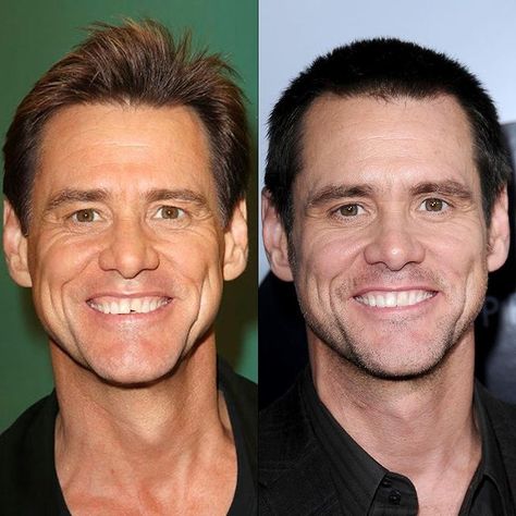 JimCarrey, toothbonding, smilemakeover, smile, cosmeticdentistry Teeth Bonding, Cracked Tooth, Discolored Teeth, Smile Makeover, Jim Carrey, Cosmetic Procedures, Dumb And Dumber, Self Love, San Diego