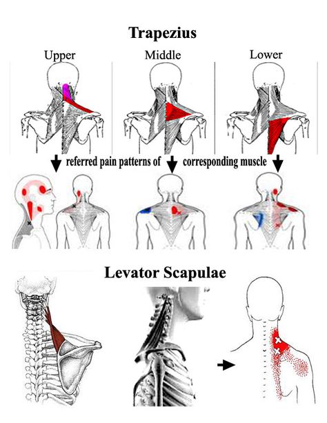 Trapezius Referred Pain Shoulder Trigger Points, Punkty Spustowe, Forward Head Posture Exercises, Referred Pain, Neck Muscles, Forward Head Posture, Massage Therapy Techniques, Trigger Point Therapy, Neck Exercises