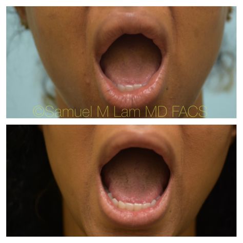 This African-American woman is shown before and  5 months after upper and lower lip reduction to correct previous bad permanent lip fillers. She also had facial fillers performed to create a more youthful and balanced face. She is shown to be younger and less bottom heavy on her face afterward. Lip Reduction, Bottom Heavy, Facial Fillers, Lower Lip, Happy Skin, Moisturizer With Spf, Lip Fillers, Prevent Wrinkles, American Woman