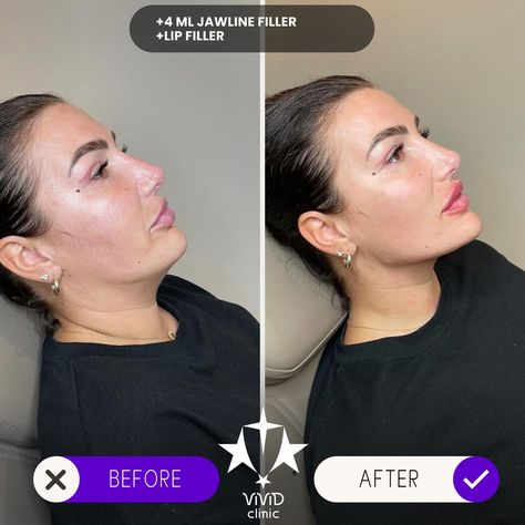 💉✨ Sculpt and define your face with Jawline Filler at Vivid Clinic! Check out this stunning Client Transformation—perfectly contoured, sharper jawline for a more defined and balanced appearance. 💎 ✅ Enhances facial definition ✅ Non-surgical with immediate results ✅ Long-lasting, natural-looking transformation 💬 Want to achieve a similar look? Book your free consultation today and take the first step toward a more sculpted you! 📍Located in Istanbul, Turkey 🌐 vividclinic.net 📞 🇺🇸 +90 545 742... Face Contouring Fillers, Facial Definition, Sharper Jawline, Jawline Filler, Face Fillers, Body Ideas, Face Contouring, Lip Fillers, Istanbul Turkey