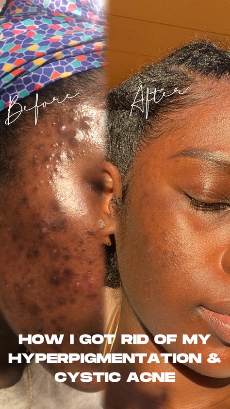 Acne Prone Skin Care Routine, Acne Hyperpigmentation, Forehead Acne, Acne Prone Skin Care, Bad Acne, Oily Skin Care Routine, Acne Skincare Routine, Black Skin Care, Face Acne