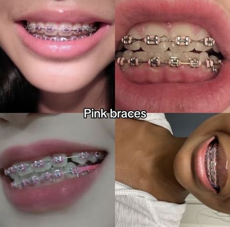 Braces Colors Dark Skin, Light Green Braces, Pink And Blue Braces, Pink Power Chain Braces, Braces Colors That Make Teeth Look White, Lilac Braces, Light Pink Braces, Hot Pink Braces, Brackets Aesthetic