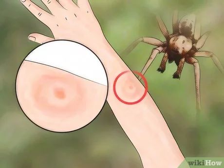 How to Identify a Spider Bite: 7 Steps (with Pictures) - wikiHow Spider Bites Remedies, Treating Spider Bites, Spider Bites Pictures, Recluse Spider Bite, Brown Recluse Spider Bite, Itchy Scalp Remedy, Spider Bite, Brown Recluse Spider, Spider Species