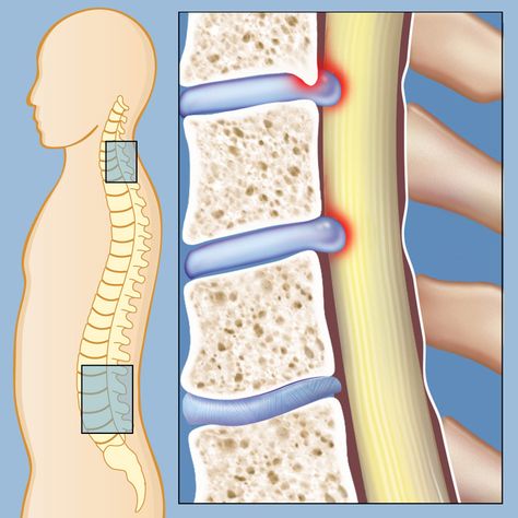 Spinal stenosis is a condition in which open spaces within the spine become narrowed, causing pressure on the spinal cord and nerves of the spine... ~ You only have One Spine, so take Good Care of It! An important reminder from http://www.familychiropractic.com.sg/ What Is Stem, Cord Blood Banking, Psoas Muscle, Spine Surgery, Muscle Weakness, Sciatica Pain, Sciatic Nerve, Spinal Cord, Hip Flexor