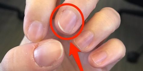 Your nails are more than a thing to polish. They could be signals of serious health problems. Nail Symptoms, Fingernail Health, Peeling Nails, Nail Conditions, Throbbing Headache, Nail Vitamins, Curved Nails, Weak Nails, Vitamin Deficiency