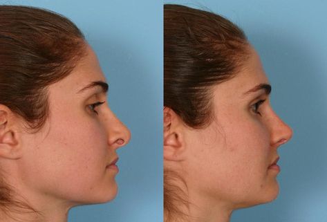 Rhinoplasty Before And After, Facial Plastic Surgery, Nose Contouring, Facial Plastic, Before After Photo, After Photos, Plastic Surgery, Square Sunglasses Men, Surgery