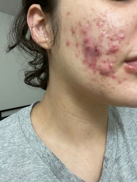 Really Bad Acne, Acne Photos, Acne Pictures, Acne Positivity, Closed Comedones, Skin Positivity, Skin Blackheads, Massage Images, Get Rid Of Pimples