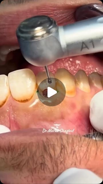 Dentistry on Instagram: "Post by • @dentistrysociety_ Deep Caries Removal ✨️
•
•
➖
📽By @dr_morad_shaglouf 
•

 #dent #dentallogo #dentalassistant #dentalcare #dentalinstruments

#dentist #dentista #dental #toothlessedit" Dental Advice, Tooth Crown, Dental Posts, Tooth Removal, Dental Logo, Tooth Extraction, Dental Cosmetics, Periodontal Disease, Dental Instruments