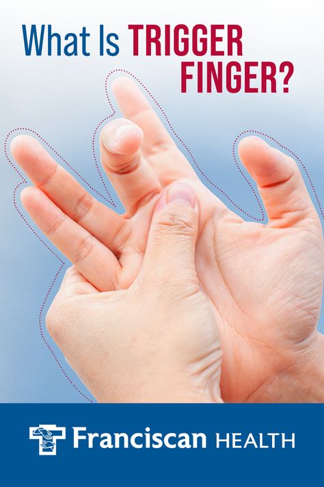 Trigger finger is extremely common - and very treatable. If you’ve noticed pain and limited motion in your finger, ask your doctor about steps to treat trigger finger today. Stiff Fingers Hands, Arthritic Hand Pain Relief, Trigger Finger Remedies, Tingling In Fingers, Thumb Pain Relief, Trigger Finger Exercises, Hand Therapy Exercises, Hand Problems, Finger Stretches