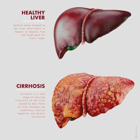 Medical illustration depicting the differences between a healthy liver and one with cirrhosis. Expertly illustrated by Linda Lubbersen, founder of #StudioLindalu. Explore more work by Studio Lindalu on the Medical Illustration & Animation Sourcebook online site. #scienceillustration #scienceart #scienceartist #scientificillustration #scientificvisualization #science #medicine #medicalillustration #illustration #anatomy #pathology #liver #cirrhosis #research #organs #health #disease #editorial Liver Drawing, Liver Illustration, Organs Illustration, Human Liver Anatomy, Liver Organ, Human Body Science Projects, Illustration Anatomy, Liver Anatomy, Biology Anatomy