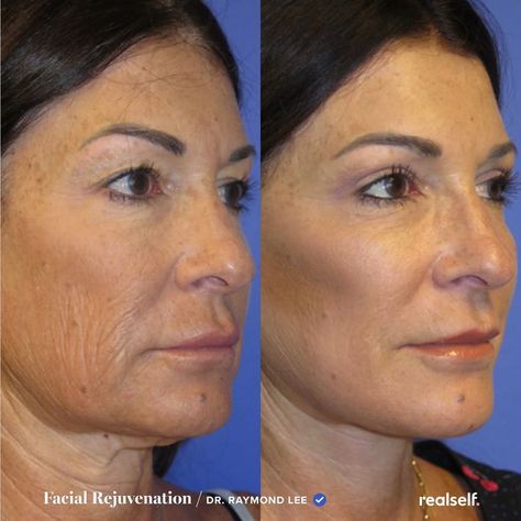 Facelift Recovery, Lower Face Lift, Neck Lift Surgery, Local Anesthesia, Facial Procedure, Face Lift Surgery, Eyelid Lift, Neck Surgery, Plastic Surgery Procedures