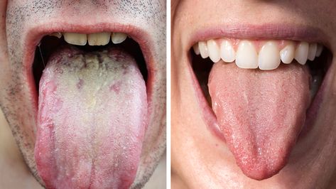 Researchers Explain What The Color of Your Tongue Says About Your Health Yellow Tongue, Healthy Tongue, White Tongue, Sunburn Relief, Coconut Health Benefits, Tongue Health, Nail Care Tips, Benefits Of Coconut Oil, Power Of Positivity