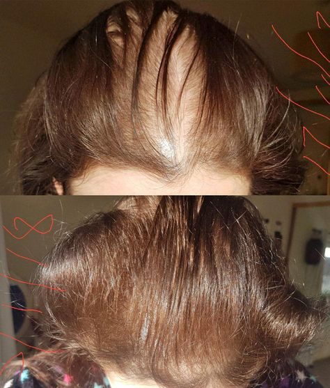 This Drugstore Product Regrew a Woman's Thinning Hair in 6 Weeks and the Pics Are Unreal Thinning Hairline Women, Thining Hair Remedy, Thinning Hair Remedies Women, Thinning Hair Women, Grow Hair Back, Thining Hair, Thinning Hair Remedies, Hair Growth Formula, Natural Hair Removal