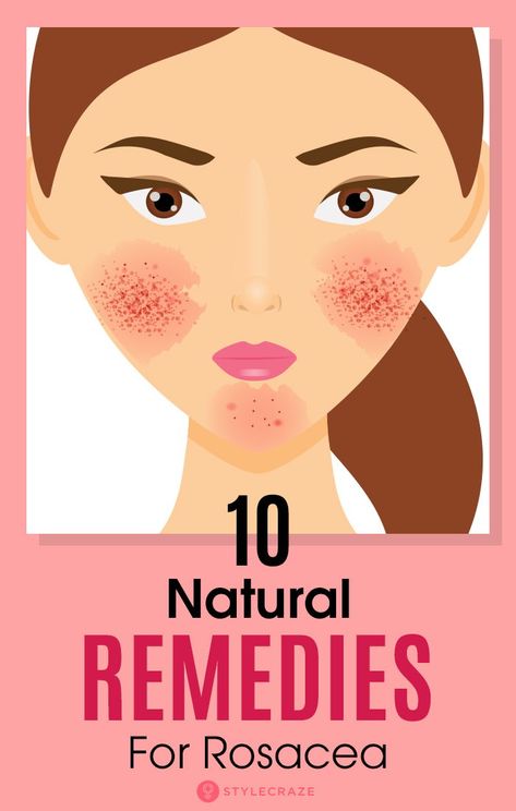 Skin Natural Remedies, Skin Disorders, Skin Care Essentials, Skin Conditions, Health Remedies, The Skin, Home Remedies, Natural Remedies, Skin Care Tips