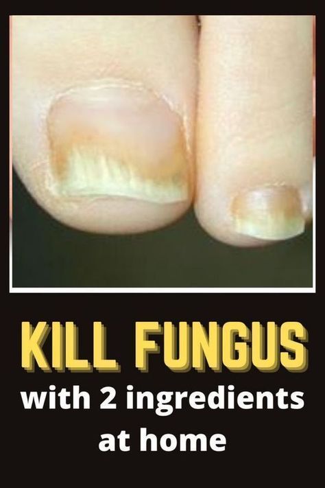 Fungal Nail Infections Homemade Nail Polish, Toenail Fungal Infection, Nail Remedies, Fingernail Fungus, Toenail Fungus Remedies, Nail Problems, Nail Infection, Nail Fungus Remedy, Fungal Nail