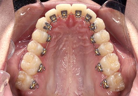 Not all patients have problems that can be corrected with plastic aligners alone. Clear brackets have been around for decades, but up-close they still look like braces. Recent advances in 3D imaging and CAD/CAM technology (Suresmile) have facilitated a third option called “lingual braces.” #DrJBlog #Jorgensen😃 #JorgensenOrtho #Braces #Invisalign #Smile #Orthodontics #Ortho #Lingual Braces Before And After, Lingual Braces, Braces Cost, Invisalign Braces, Adult Braces, Traditional Braces, Invisible Braces, Dentistry Student, Braces Colors