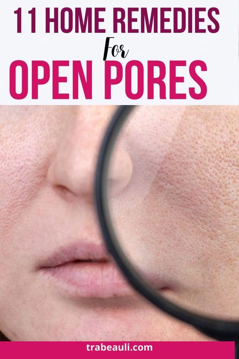 So, Trabeauli has brought you some amazing home remedies for open pores, which will help in reducing the pore size and tighten them. Check them out- #TopRatedAntiAgingSkinCare Acne Prone Skin Care, Lotion For Oily Skin, Tips For Oily Skin, Oily Skin Acne, Cream For Oily Skin, Anti Wrinkle Skin Care, Open Pores, Eye Skin Care, Skin Care Wrinkles