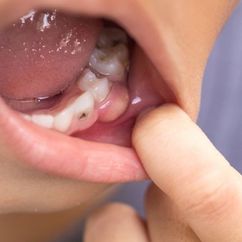 There are several ways you can stop cavities before it gets worse.  Learn more here: https://ift.tt/2DJQjxK      #lincolndentalcenter#coquitlam#poco #dentistcoquitlam#lincolnstation #dentistincoquitlam #coquitlamdentist#coquitlamdentists #coquitlam#lincolndental #invisalign#veneers#crowns#fillings #bridge#teethwhitening#zoom #zoomteethwhitening#laser #orthodontics#rootcanal#tricity #dental#dentist#dentistry #familydental #cosmeticdentistry #teethcleaning Dental Infection, Dental Extraction, Tooth Infection, Kedokteran Gigi, Medical Marketing, Homemade Facial Mask, Oral Surgeon, Family Dental, How To Prevent Cavities