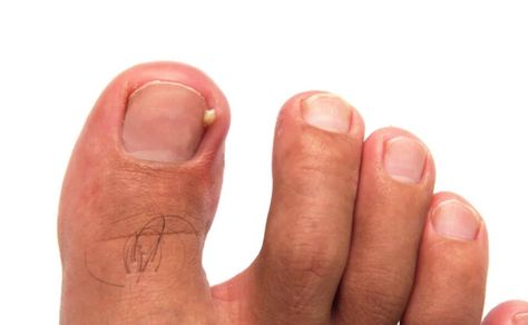 Learn about the common and bothersome issue of ingrown toenails. Learn about their causes, at-home remedies, and the crucial signs that indicate it's time to seek professional intervention. Learn everything you need to know about Ingrown toenails in our article below! #IngrownToenail #FootHealth #FeetFirstClinic #TorontoHealth Toenail Pain, Toenail Problems, Nail Problems, Nail Infection, Ingrown Toenail, Shaving Tips, Ingrown Nail, Hard Nails, How To Grow Nails