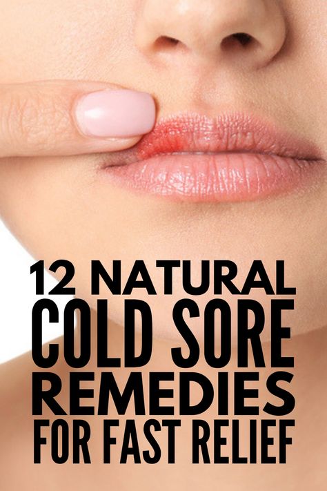 Fever Blister Remedy, Cold Sore Remedies, Blister Remedies, Blister On Lip, Natural Cold Sore Remedy, Fever Blister, Cold Sores Remedies, Brown Spots On Face, Spots On Face