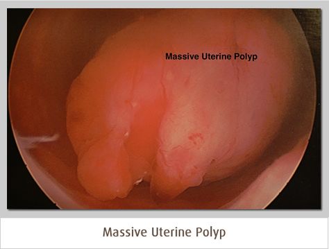 Polyps Uterus, Uterine Polyps, Health Conditions, Foods To Avoid, Health Info, Fertility, Womens Health, Health Tips, Conditioner