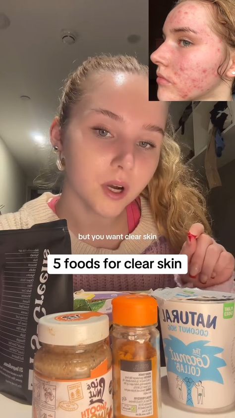 5 foods of clear skin Reasons Of Acne On Face, How To Improve Acne, Skincare Bumpy Skin, Hiding Acne With Makeup, Natural Acne Scar Remedy, Even Out Skin Tone Naturally, How Is Your Skin So Clear, How To Have Beautiful Skin, Tea For Acne Clear Skin