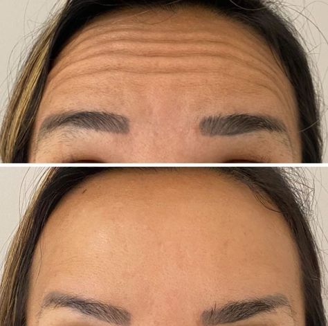 Armonizacion Facial, Face Injections, Face Plastic Surgery, Botox Facial, Cosmetic Web, Face Fillers, Hair Job, Facial Fillers, Cosmetic Injectables