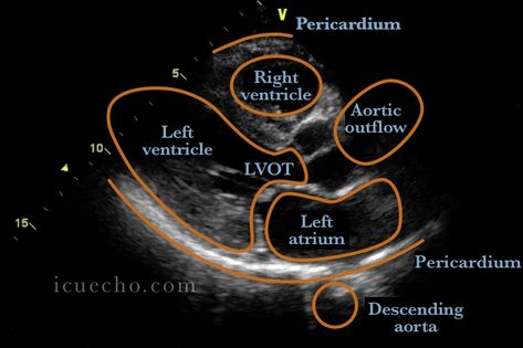 Parasternal long axis - ICU & Echo Echo Cardiography, Echo Tech Cardiac, Diagnostic Medical Sonography Student, Cardiac Sonography, Ultrasound Sonography, Sonography Student, Medical Ultrasound, Ultrasound Technician, Diagnostic Medical Sonography