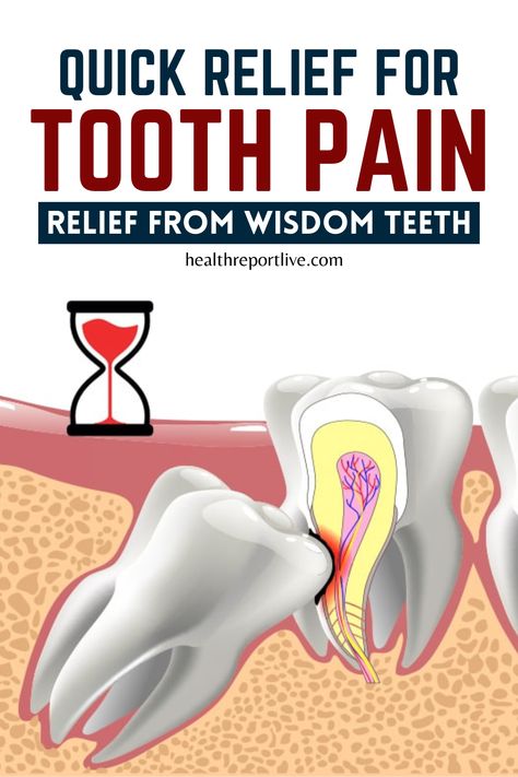 Quick Relief for Tooth Pain Relief From Wisdom Teeth Tooth Ache Relief Remedies Diy, Cloves For Tooth Pain, Home Remedies For Tooth Pain, Natural Tooth Pain Relief, Tooth Pain Relief Severe, Wisdom Tooth Pain Relief, Wisdom Teeth Pain Relief, Tooth Pain Remedies, Impacted Wisdom Teeth