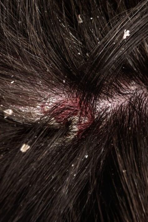 Discover the potential of baking soda in treating scalp fungus and dandruff. Learn about home remedies and its effects on common skin conditions. Scalp Fungus, Ring Worm Remedies, Dandruff Home Remedies, Dandruff Remedy Severe, Seborrheic Dermitis On Scalp, Itchy Scalp Remedy, Baking Soda For Dandruff, Antifungal Cream, Dandruff Remedy