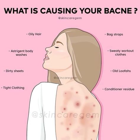 Struggling with back acne? Here are the possible causes Charlotte Tillbury, Back Acne, Hotel Hacks, Skincare Routines, Acne Causes, Sweaty Workouts, Body Acne, Beauty Routine Tips, Treat Acne