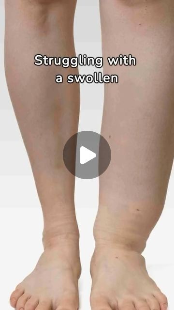 Swollen Legs Remedies, Celtic Salt, Dandelion Tea, Lymph Drainage, Swollen Legs, Fluid Retention, Health Recipes, Back Pain Exercises, Nutritional Yeast