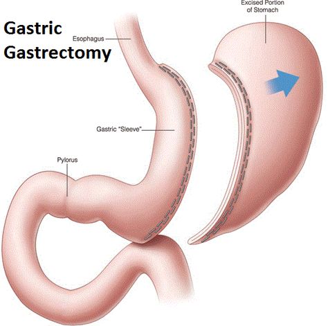 Vertical sleeve gastrectomy is surgery to help with weight loss. The surgeon removes a large portion of your stomach. The new, smaller stomach is about the size of a banana. It limits the amount of food you can eat by making you feel full after eating small amounts of food. Smaller Stomach, Stomach Sleeve, Vertical Sleeve Gastrectomy, Vision Bored, Surgery Doctor, Sleeve Gastrectomy, Surgical Technologist, Bariatric Diet, Sleeve Surgery