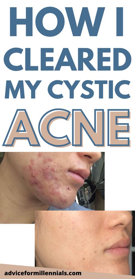 This is a detailed post about how I cleared my cystic acne without accutane. It was a long and painful journey, but I really want to share with you the products I used to heal my skin. Skincare | adult acne solutions | hormonal acne | adult acne Back Acne Remedies, Cystic Acne Remedies, Face Mapping Acne, Forehead Acne, Acne Prone Skin Care, Acne Overnight, Bad Acne, Acne Skincare Routine, Natural Acne Remedies